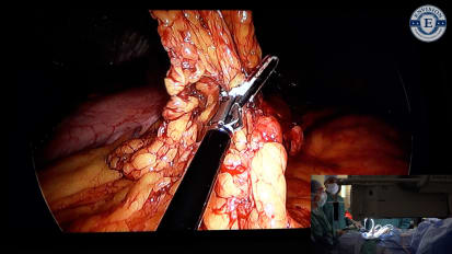 Live Laparoscopic Colectomy