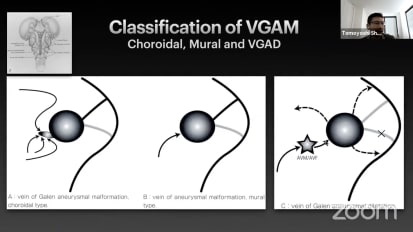 Entrance to the Vein of Galen Aneurysmal Malformation