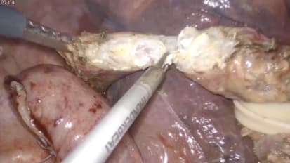 Esophagectomy with THUNDERBEAT