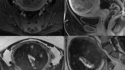 Overview of Fibroids