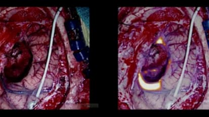 Fluorescent-­Guided Brain Tumor Resection