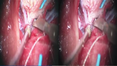 Focused Transsylvian Approach for a Left Posterior Insular Cavernous Malformation: 3D Operative Video