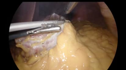 Gastric Sleeve with THUNDERBEAT