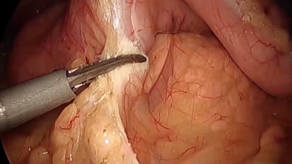 Gastric Sleeve with THUNDERBEAT