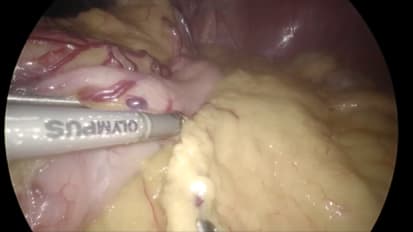 Gastric Volvulus with THUNDERBEAT