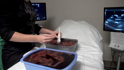 Grapes, Jello aid precision fetal cath