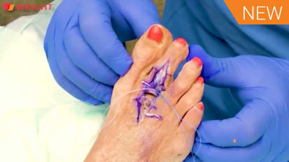 GRAVITY™ Plantar Plate Repair System surgical highlights and tips and tricks with Dr. James Sferra [AP-014339A]