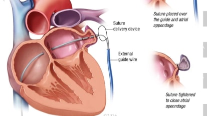 Leaks after percutaneous left atrial appendage occlusion and stroke risk