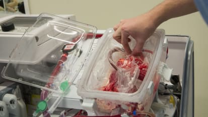 How To Grow Your Heart Transplant Program in 2019