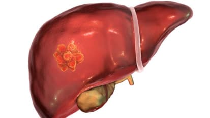 The Evolving Field of Hepato-Oncology