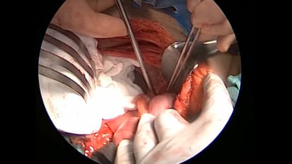 Aortoiliac Bypass: Exposing Right Iliac Artery for a Distal Anastomosis