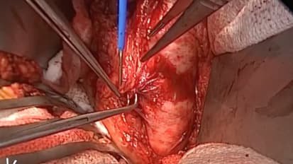 Open Aorta Proximal Anastomosis Case - Part 2 of 4