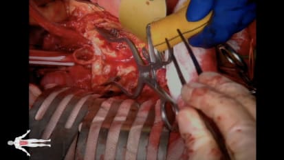 Open Aortic Aneurysm Repair 