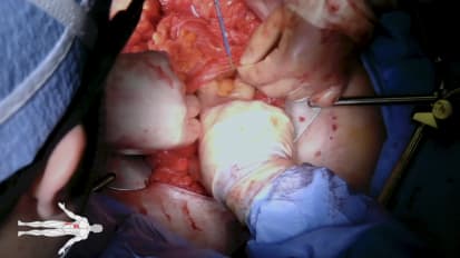 Open IVC Filter Removal 
