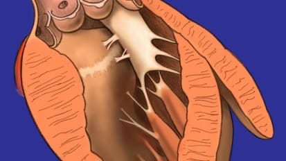 Managing hypertrophic cardiomyopathy: New guidelines and drugs