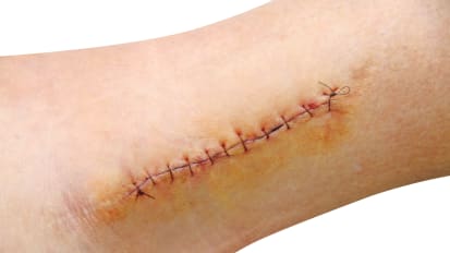 Positive Outcomes from Negative Pressure: The Current State of Surgical Incision Management