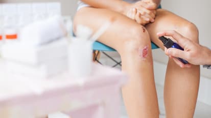 Understanding Stalled Wounds: The science behind Collagen/ORC