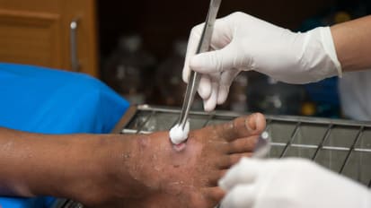 V.A.C. VERAFLO™ Therapy and Its Value in Comparison to NPWT Without Instillation