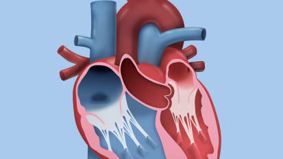 Robotic Mitral Valve Surgery