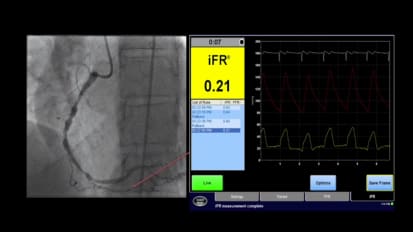 See how iFR Co-registration can change treatment decisions in comparison to angiography 