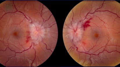 Palpating the brain with MR elastography to detect raised intracranial pressure