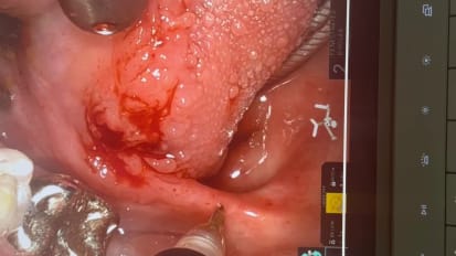 Tongue squamous cell carcinoma