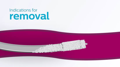 Indications for removal 