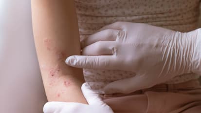 Atopic Dermatitis -The Old and the New