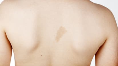 Neurofibromatosis and Schwannomatosis: Identifying Patients and Optimizing Care at Every Age