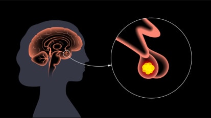 Optimizing Perioperative Outcomes in Pituitary Tumor Surgery: An Endocrine Approach