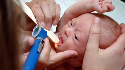 Infant-Mom Feeding Troubles: How to Assess Tongue-Ties and Other Factors