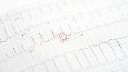 Pulsed Field Ablation- First-Line Treatment for Atrial Fibrillation: Precision, Safety, and Innovation Redefined