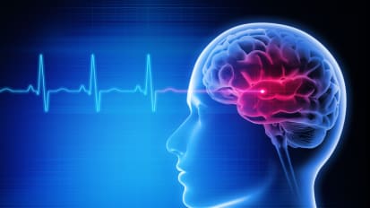 Updates in Stroke Prevention: What Every PCP Needs to Know