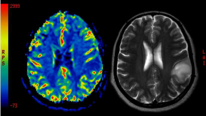 Low-Intensity Focused Ultrasound (LIFU) for Non-Small Cell Lung Cancer Brain Metastases
