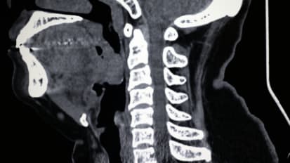 Diffuse Idiopathic Skeletal Hyperostosis: A Common Cause of Spinal Pain