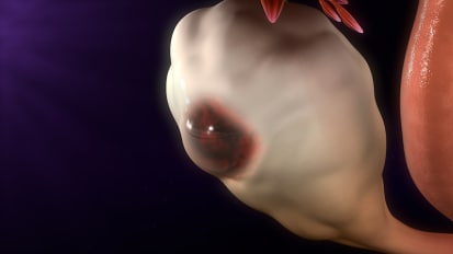 Stages of Endometriosis