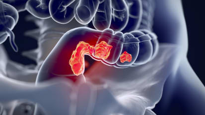 Nonoperative Management After Neoadjuvant Therapy for Rectal Cancer: A Single Institution Experience Over 5 Years