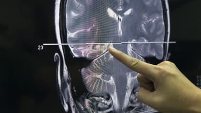 Case Presentation: Brachytherapy to Treat Recurrent Brain Metastasis