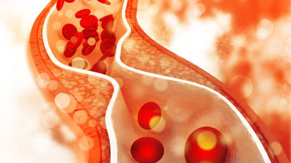 Unclog the Arteries: Treatment Options for Arterial Disease