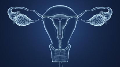 Treatment Options for Fibroids