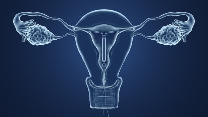 Treatment Options for Fibroids