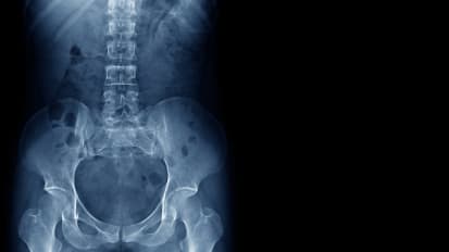 Dealing with the Side Effects of Pelvic Radiation