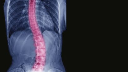 Cervical and Thoracolumbar Spinal Deformity Treatment Strategies, Part II: Radiographic Parameters