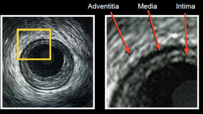 IVUS Image Interpretation- virtual series of ten