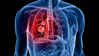 Advances in Lung Sparing Surgery