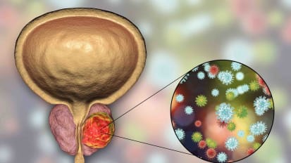 Using the Latest Technology and Techniques in Prostate Radiation