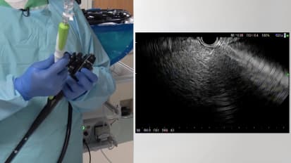 EUS-Guided Liver Biopsy Technique and Case Study by Harshit Khara, M.D., Danville, PA