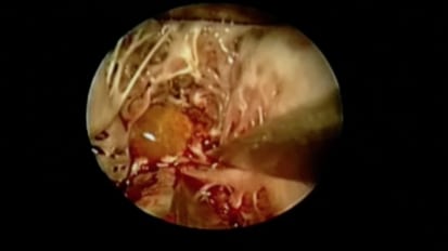 Cardiac Masses and Sources of Emboli: Role of Echo/CMR/CT - Part 1 of 2