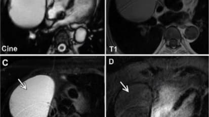 Cardiac Masses and Sources of Emboli: Role of Echo/CMR/CT - Part 2 of 2