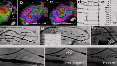 Alcohol Ablation: Making a Come-Back Through the Back Door